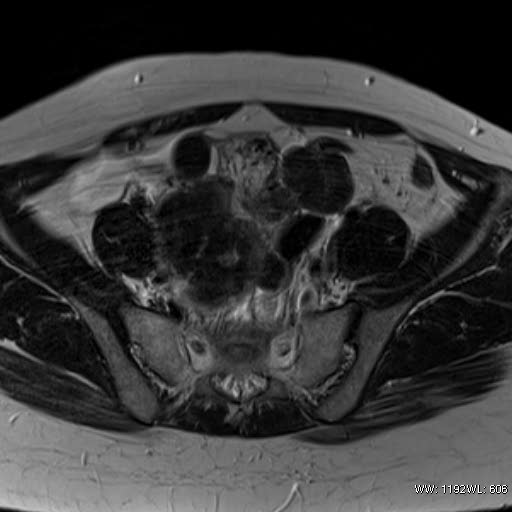 File:Broad ligament fibroid (Radiopaedia 49135-54241 Axial T2 12).jpg
