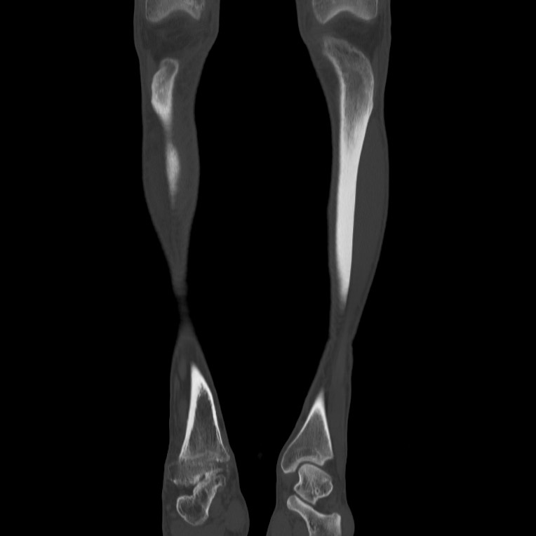 Brodie abscess - tibia (Radiopaedia 66028-75204 Coronal bone window 3).jpg