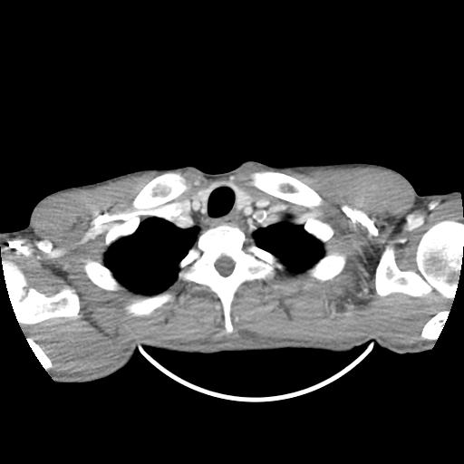 Bronchial carcinoid tumor causing right lower lobe collapse (Radiopaedia 83495-98594 A 1).jpg