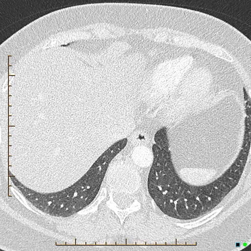File:Bronchial diverticula (Radiopaedia 79512-92676 Axial lung window 173).jpg