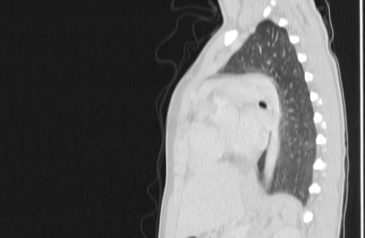 Bronchial mucoepidermoid carcinoma (Radiopaedia 57023-63895 Sagittal lung window 114).jpg