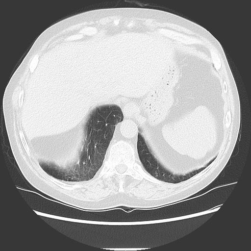 Bronchial stenosis - lung transplant (Radiopaedia 73133-83848 Axial lung window 52).jpg