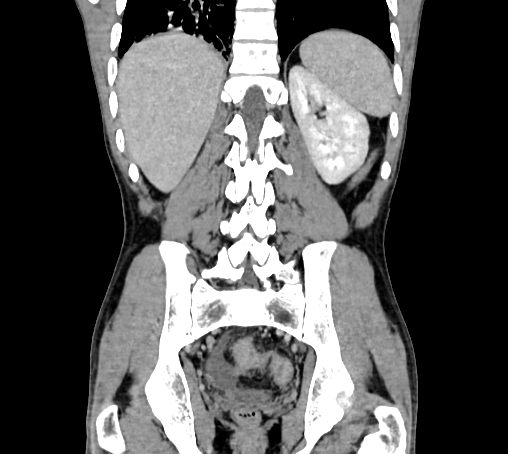 File:Bronchiectasis in Crohn disease (Radiopaedia 60311-67977 C 62).jpg