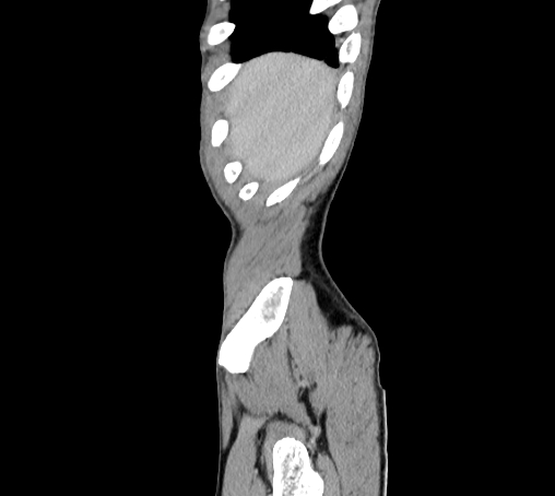 File:Bronchiectasis in Crohn disease (Radiopaedia 60311-67977 D 1).jpg
