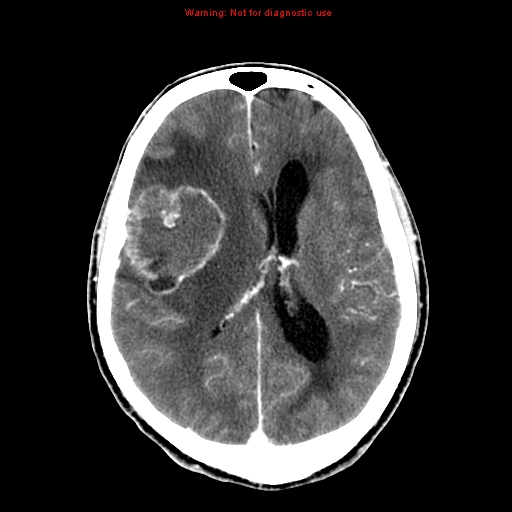 File:Bronchogenic carcinoma brain metastasis (Radiopaedia 9286-9970 B 17).jpg