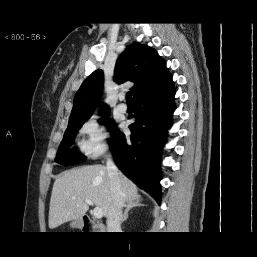 File:Bronchogenic cyst - posterior mediastinal (Radiopaedia 43885-47364 B 37).jpg