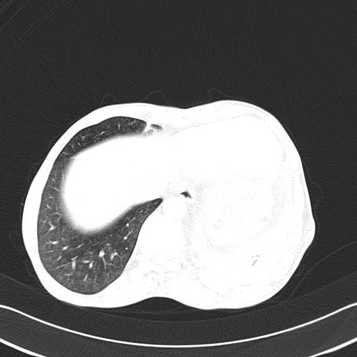 Bronchopleural fistula secondary to tuberculosis (Radiopaedia 20415-20322 Axial lung window 47).jpg
