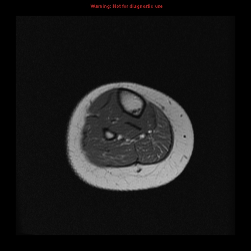 File:Brown tumor (Radiopaedia 12318-12597 Axial T1 32).jpg