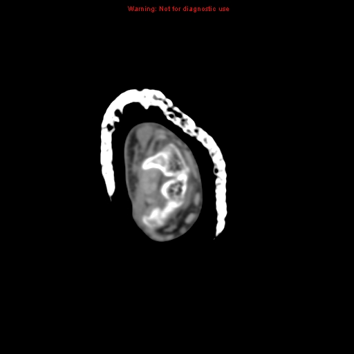 Brown tumor (Radiopaedia 12460-12694 Axial non-contrast 6).jpg