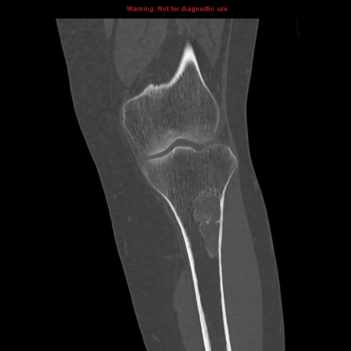 File:Brown tumors (Radiopaedia 9666-10291 Coronal bone window 14).jpg