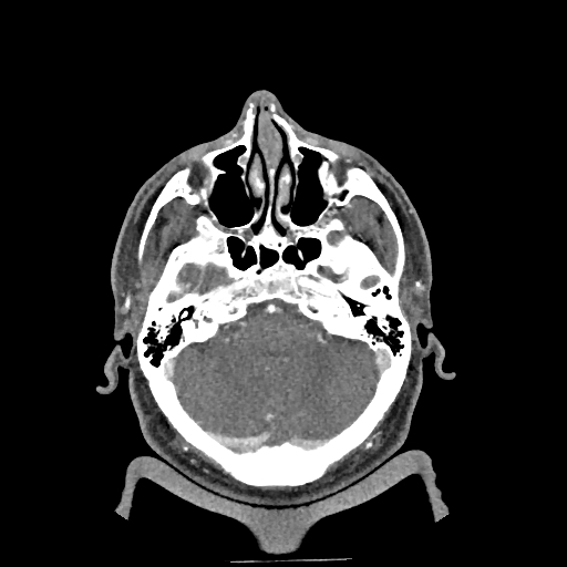 Buccal fat pad arteriovenous malformation (Radiopaedia 70936-81144 D 257).jpg