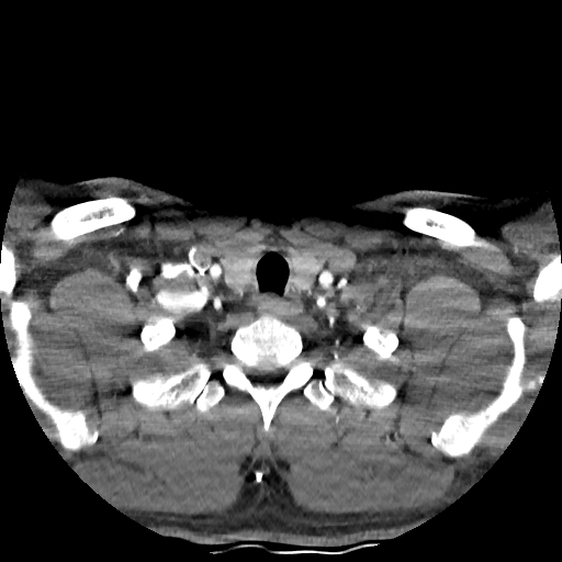 Buccal fat pad arteriovenous malformation (Radiopaedia 70936-81144 D 50).jpg