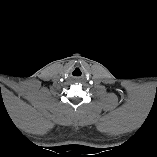 Buccal fat pad arteriovenous malformation (Radiopaedia 70936-81144 D 98).jpg