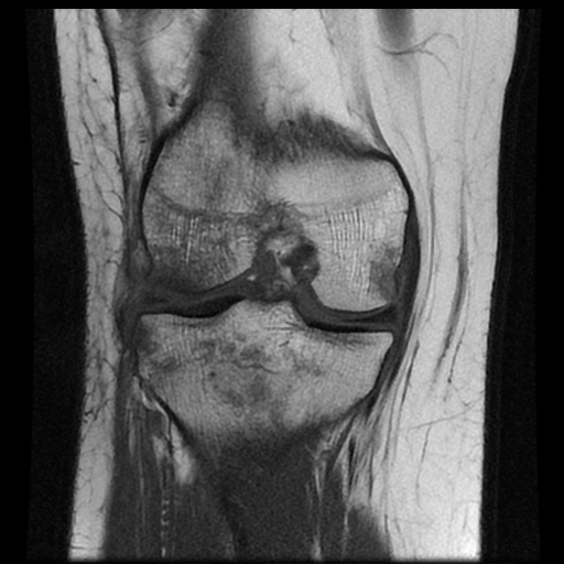 File:Bucket handle meniscus tear (Radiopaedia 56916-63751 Coronal T1 12).jpg