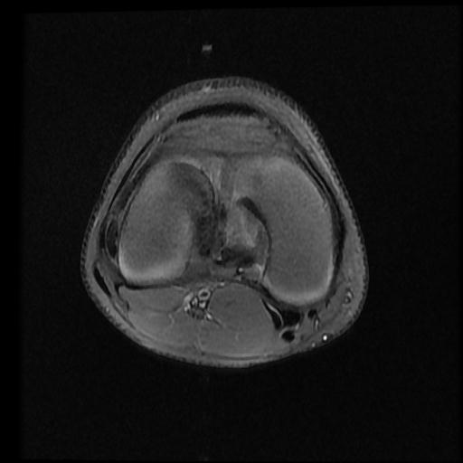 File:Bucket handle tear - lateral meniscus (Radiopaedia 72124-82634 Axial PD fat sat 9).jpg