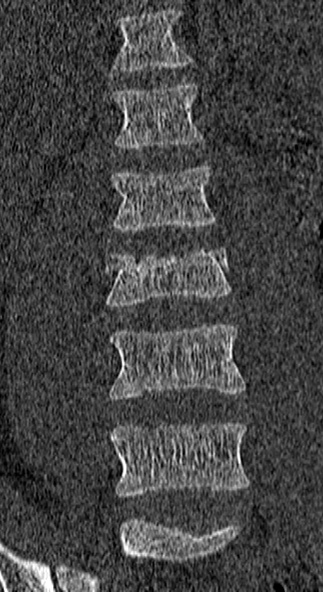 Burst fracture (Radiopaedia 53373-59357 Coronal bone window 19).jpg