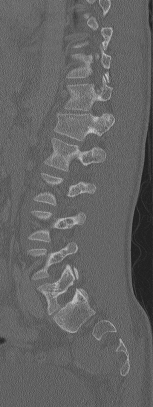 Burst fracture - T12 with conus compression (Radiopaedia 56825-63647 Sagittal bone window 29).png