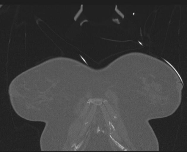 Burst fracture - thoracic spine (Radiopaedia 30238-30865 Coronal bone window 13).jpg