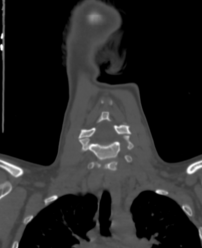 Butterfly vertebra (Radiopaedia 77903-90209 Coronal bone window 24).jpg