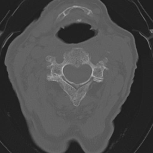 File:C2 fracture with vertebral artery dissection (Radiopaedia 37378-39199 Axial bone window 23).png