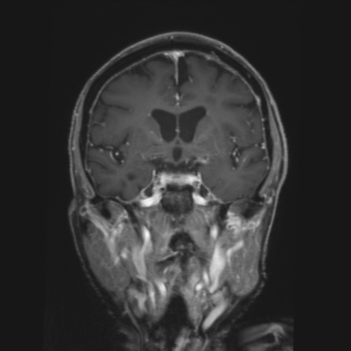 File:CNS lymphoma with steroid response (Radiopaedia 37980-39921 Coronal T1 C+ 19).png