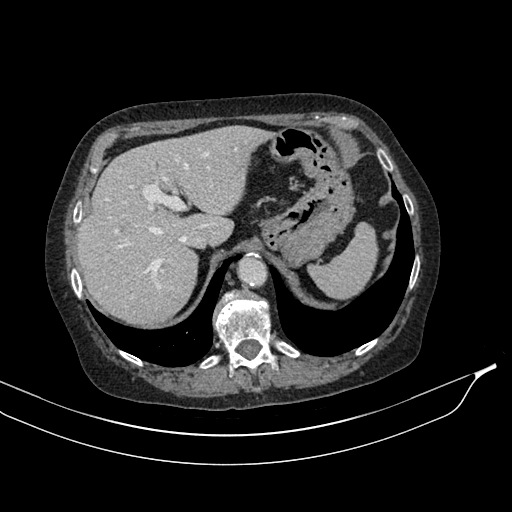 Calcified adrenal glands and Spigelian hernia (Radiopaedia 49741-54988 A 41).jpg