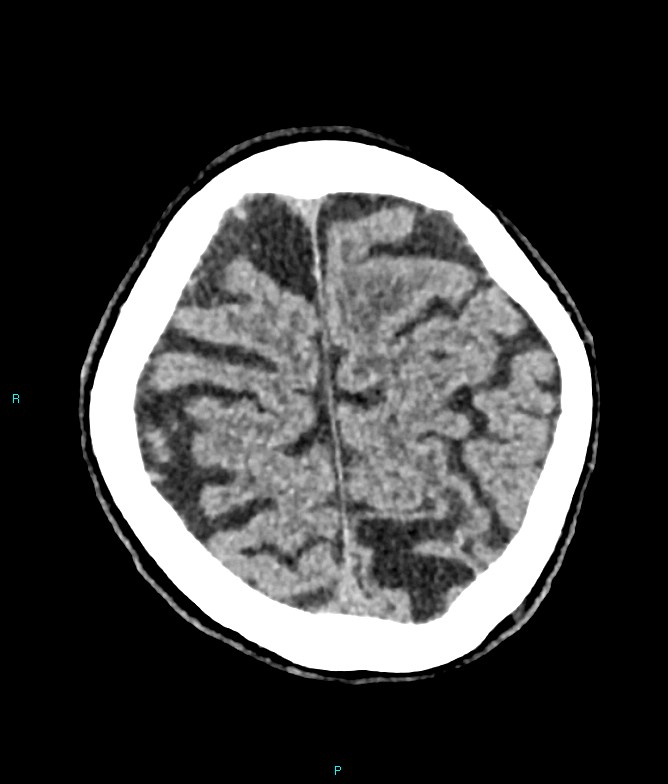 Calcified cerebral emboli from left ventricular thrombus (Radiopaedia 84420-99758 Axial non-contrast 20).jpg