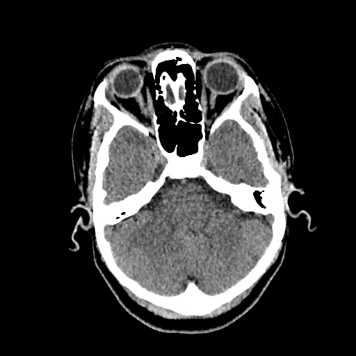 File:Calcified cerebral hydatid cyst (Radiopaedia 65603-74717 Axial non-contrast 12).jpg