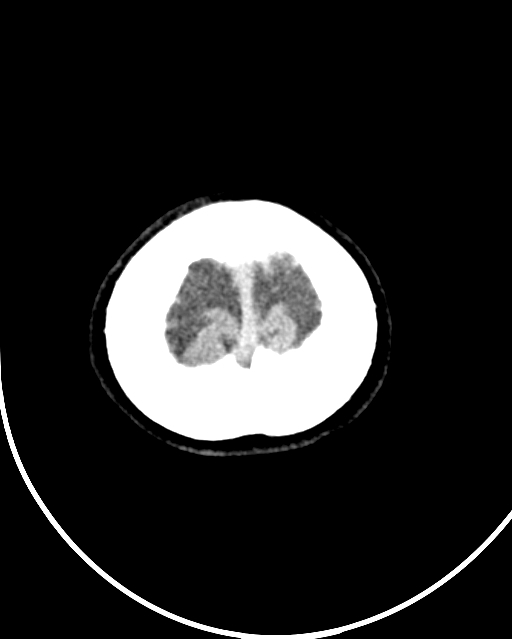Calcified meningioma (Radiopaedia 74361-85243 Axial non-contrast 3).jpg