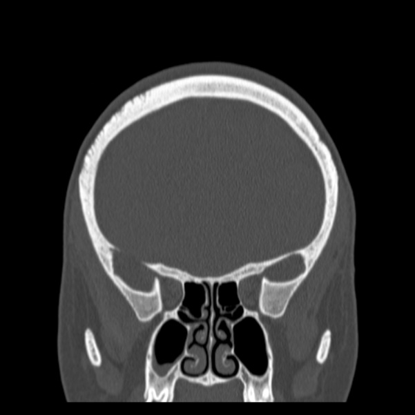 Calvarial osteoma (Radiopaedia 36520-38079 C 29).jpg