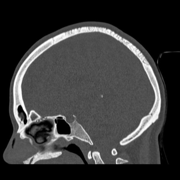 Calvarial osteoma (Radiopaedia 36520-38079 Sagittal bone window 56).jpg