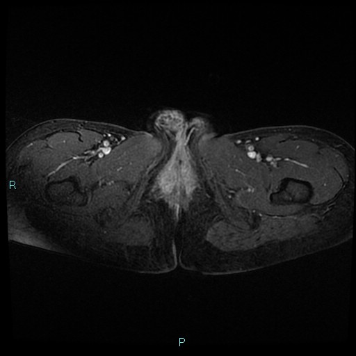 File:Canal of Nuck cyst (Radiopaedia 55074-61448 Axial T1 C+ fat sat 59).jpg
