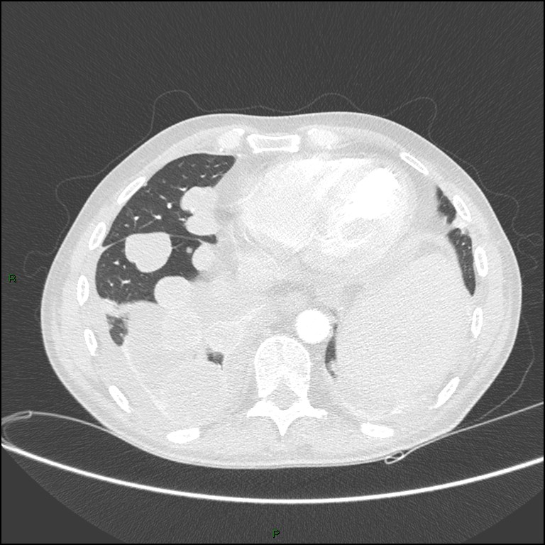 Cannonball metastases (Radiopaedia 82110-96150 Axial lung window 146).jpg