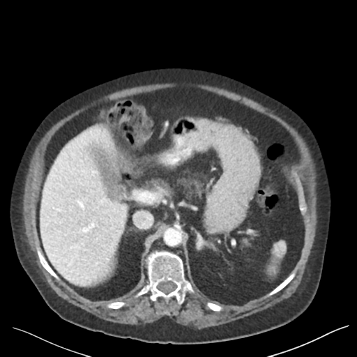 Cannonball metastases from endometrial cancer (Radiopaedia 42003-45031 E 25).png