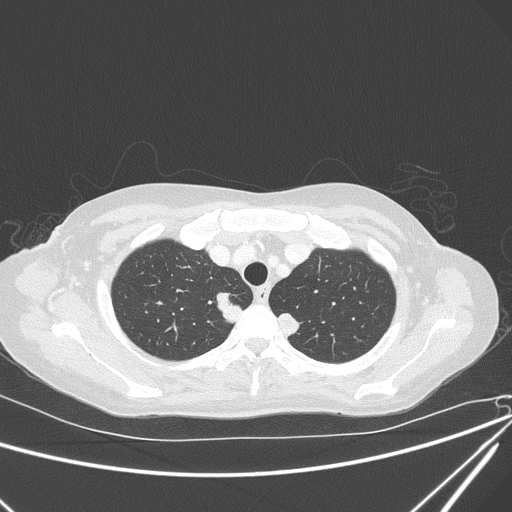 Canonball lung metastasis (Radiopaedia 77634-89837 Axial lung window 33).jpg