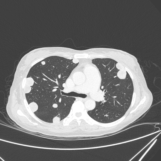 Canonball lung metastasis (Radiopaedia 77634-89837 Axial lung window 74).jpg