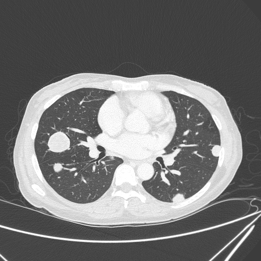 Canonball lung metastasis (Radiopaedia 77634-89837 Axial lung window 94).jpg