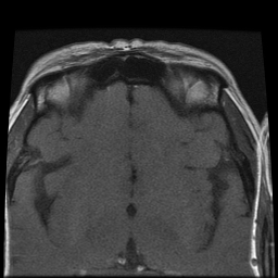 File:Carcinoid tumor of the ileum with metastasis to orbit (Radiopaedia 28165-28424 Axial T1 17).jpg