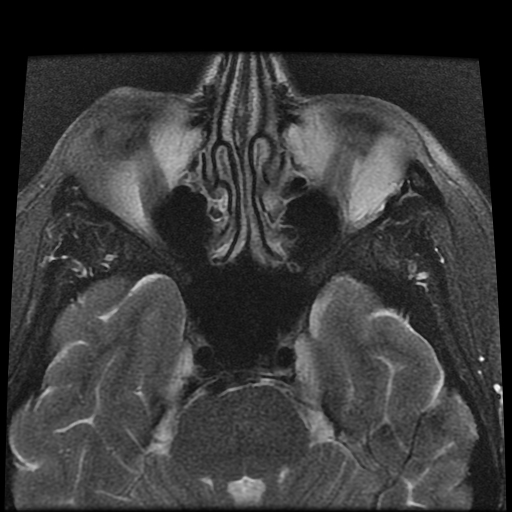 File:Carcinoid tumor of the ileum with metastasis to orbit (Radiopaedia 28165-28424 Axial T2 6).jpg