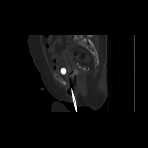 File:Carcinoma cervix- brachytherapy applicator (Radiopaedia 33135-34173 Sagittal bone window 79).jpg