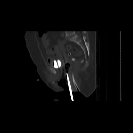 File:Carcinoma cervix- brachytherapy applicator (Radiopaedia 33135-34173 Sagittal bone window 92).jpg