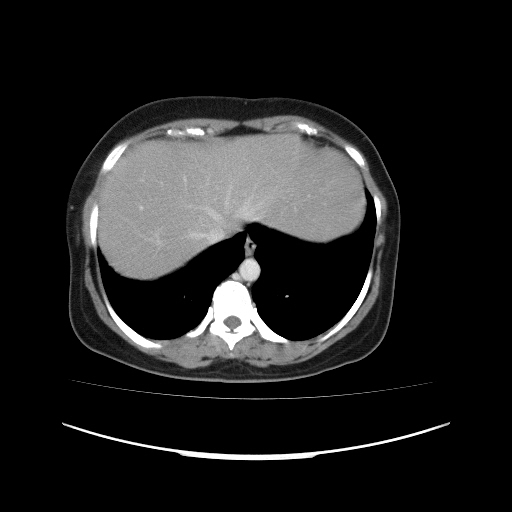 File:Carcinoma colon - hepatic flexure (Radiopaedia 19461-19493 A 18).jpg