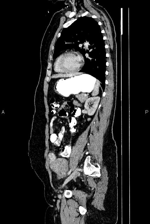 Carcinoma of uterine cervix (Radiopaedia 85861-101700 D 57).jpg