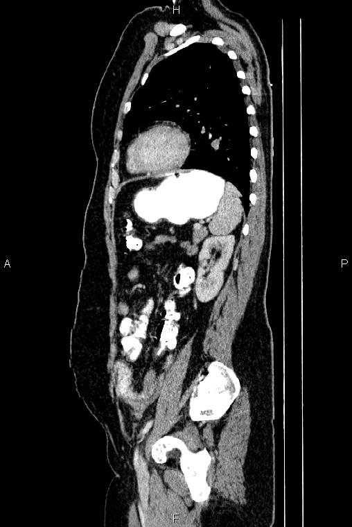 Carcinoma of uterine cervix (Radiopaedia 85861-101700 D 61).jpg
