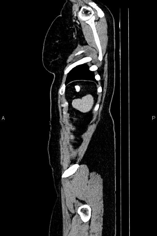 Carcinoma of uterine cervix (Radiopaedia 85861-101700 D 83).jpg