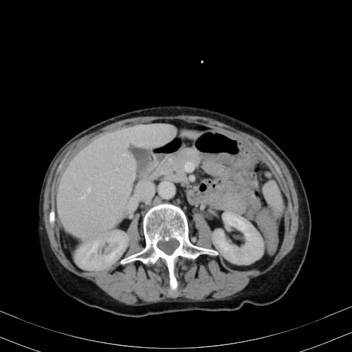 Carcinosarcoma (Radiopaedia 70401-80503 A 25).jpg