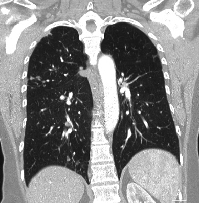 File:Cardiac sarcoidosis (Radiopaedia 74548-85534 Coronal lung window 46).jpg