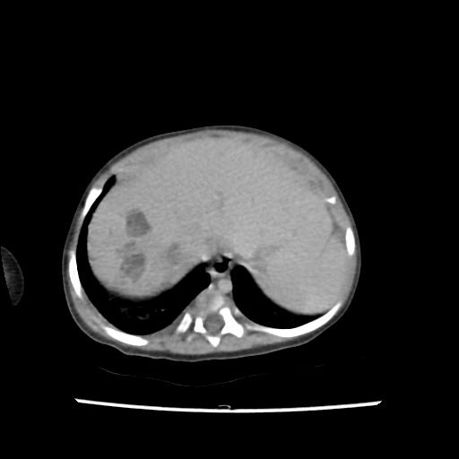 Caroli disease with autosomal recessive polycystic kidney disease (ARPKD) (Radiopaedia 89651-106703 B 24).jpg