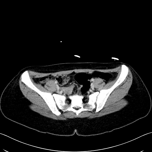 Caroli disease with medullary sponge kidney (Radiopaedia 82622-96804 C 59).jpg