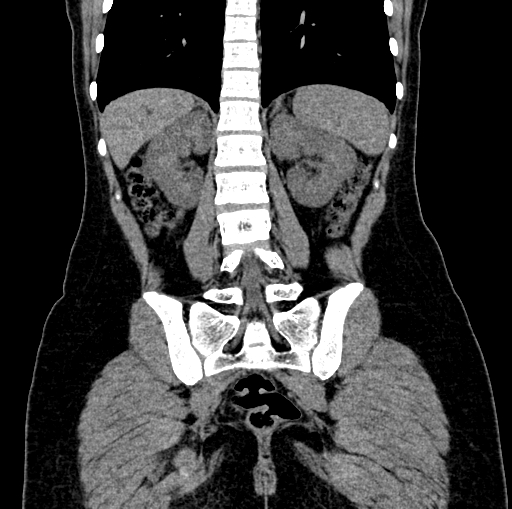 File:Caroli disease with medullary sponge kidney (Radiopaedia 82622-96804 Coronal non-contrast 1).jpg